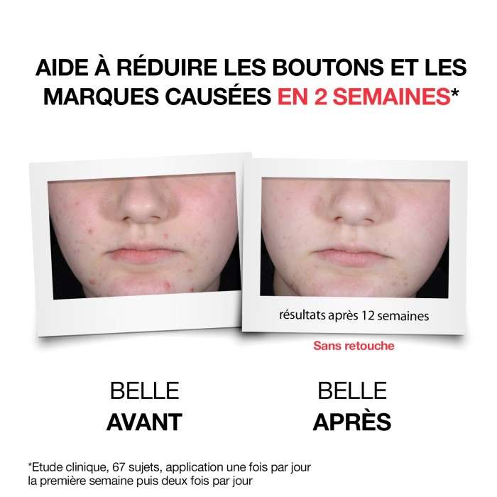 NEUTROGENA ANTI BOUTONS+ SERUM QUOTIDIEN 30ML NEUTROGENA ANTI BOUTONS+ SERUM QUOTIDIEN 30ML